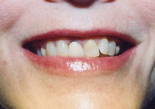 Braces and veneers before