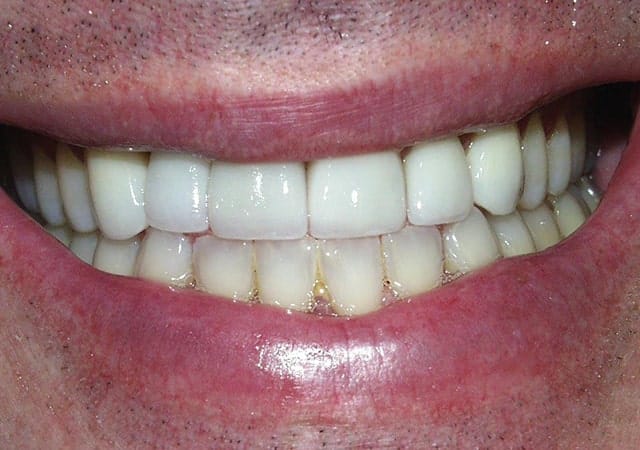 Implant and Veneers
