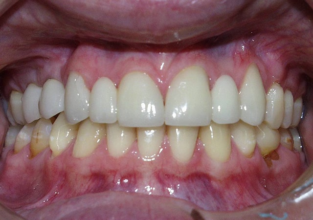Implants and porcelain bridges