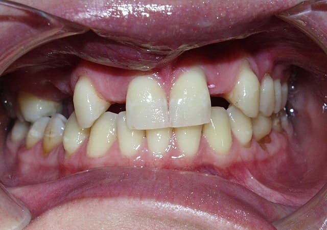 Implants and porcelain bridges before
