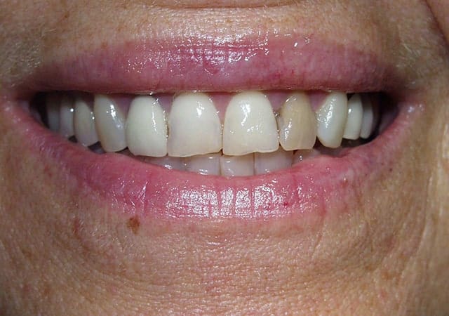 Porcelain crowns before