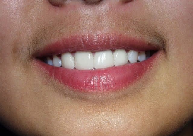 Porcelain Veneers