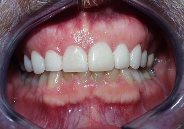 Porcelain Veneers