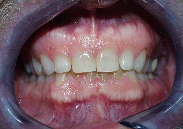 Porcelain veneers before