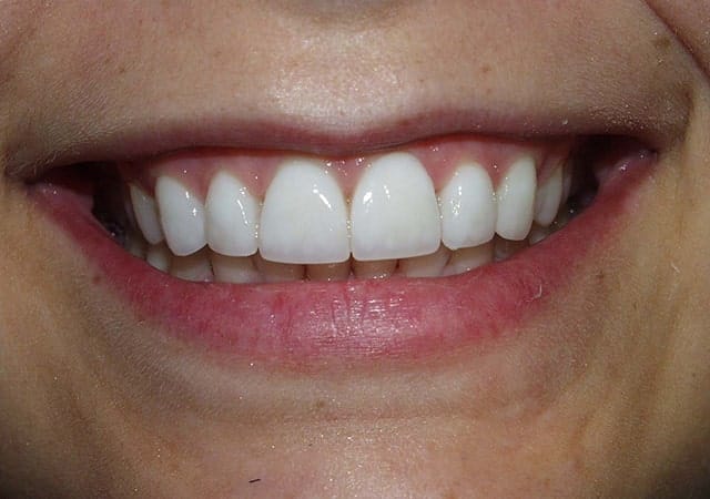 Porcelain Veneers