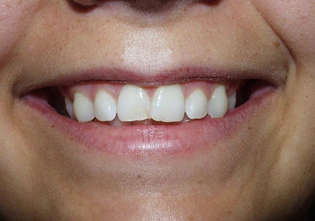 Porcelain veneers before