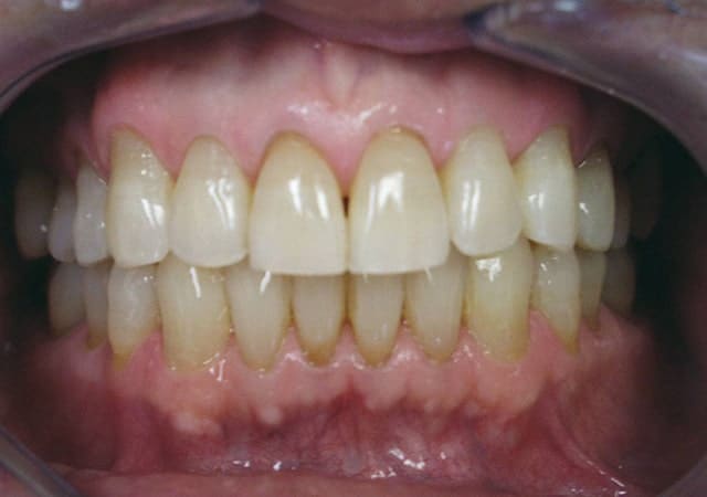 Zoom Whitening before