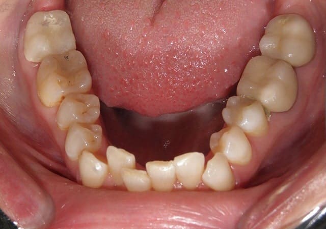 Invisalign before