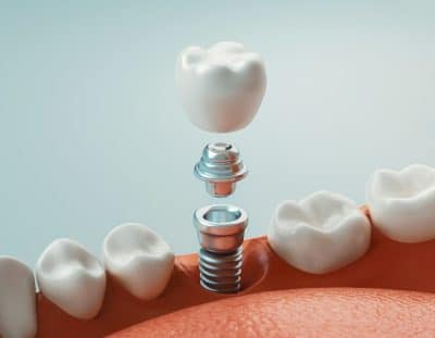 digital rendering of a dental implant